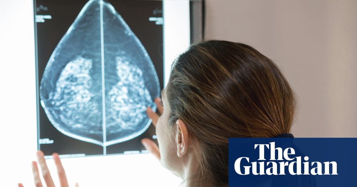 AI can detect heart disease in women using mammograms, study suggests | Women's health