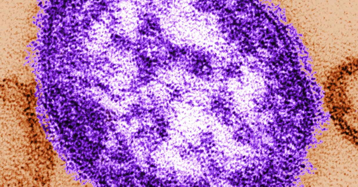 Confirmed case of measles reported in Santa Barbara County