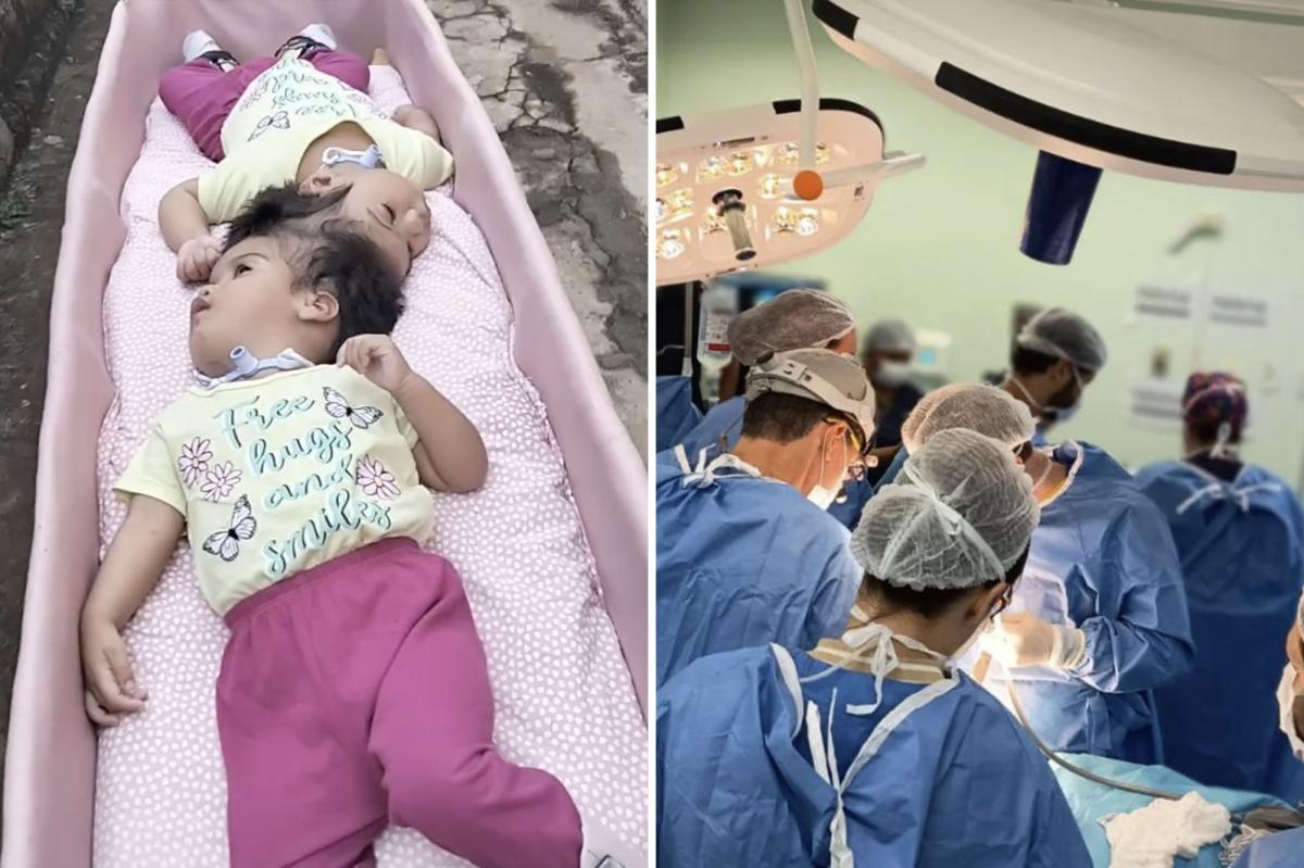 Conjoined twin girls, 2, die minutes after being separated following five grueling surgeries