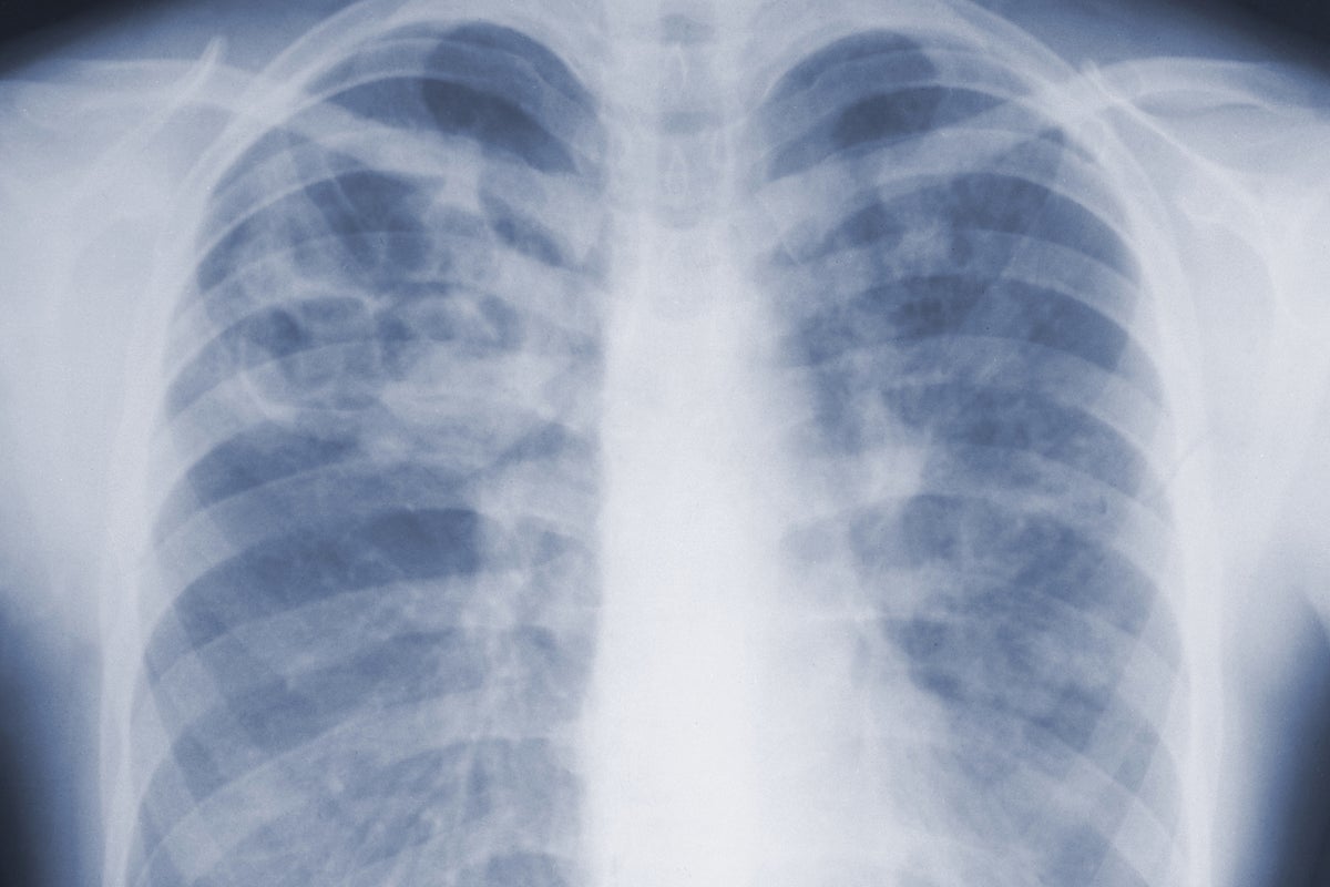 Deadly mold infections may be far more common than doctors realized, CDC study finds