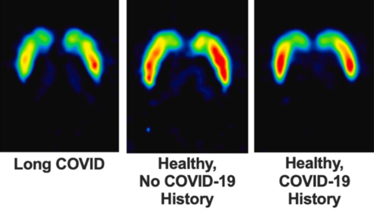 Long COVID Patients Have 18% Fewer Dopamine Nerve Endings, Brain Scans Reveal : ScienceAlert