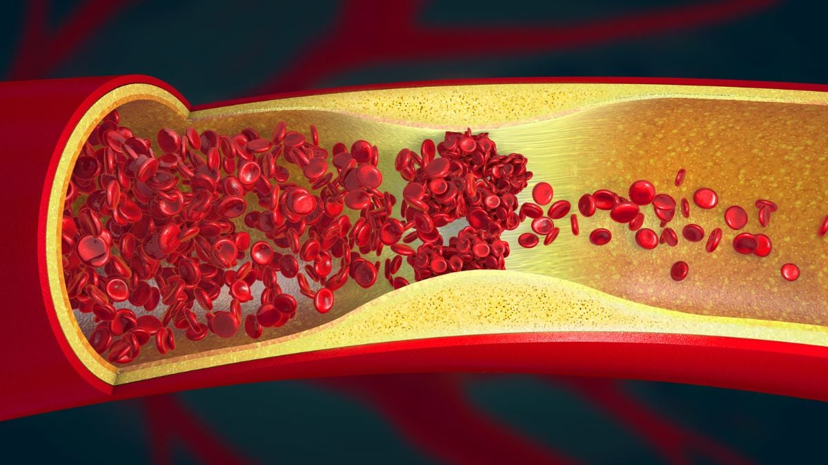 Scientists Find Signs of Artery Damage in Nearly 8 in 10 Young Adults : ScienceAlert