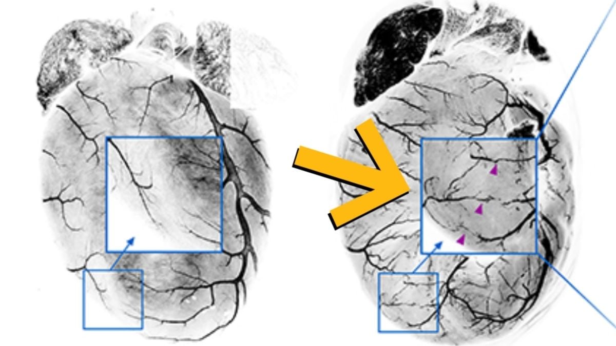 Your Heart Can Actually Build Its Own Bypass After a Heart Attack : ScienceAlert