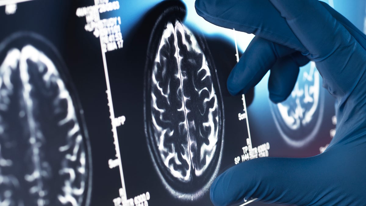 Alzheimer's Disease Threat Actually Emerges From Beyond The Brain, Study Finds : ScienceAlert