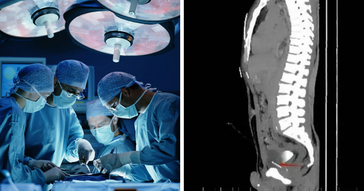 Doctors Make Damning Discovery Of 'Foreign Bodies' In Man's Chest, Pelvis, Bladder And Private Parts At Chinese Hospital