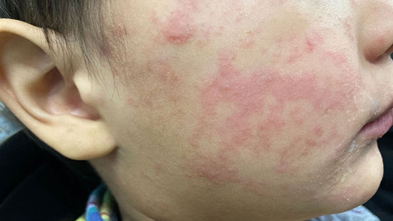 Hendersonville gas station, Asheville hotel identified as measles exposure sites