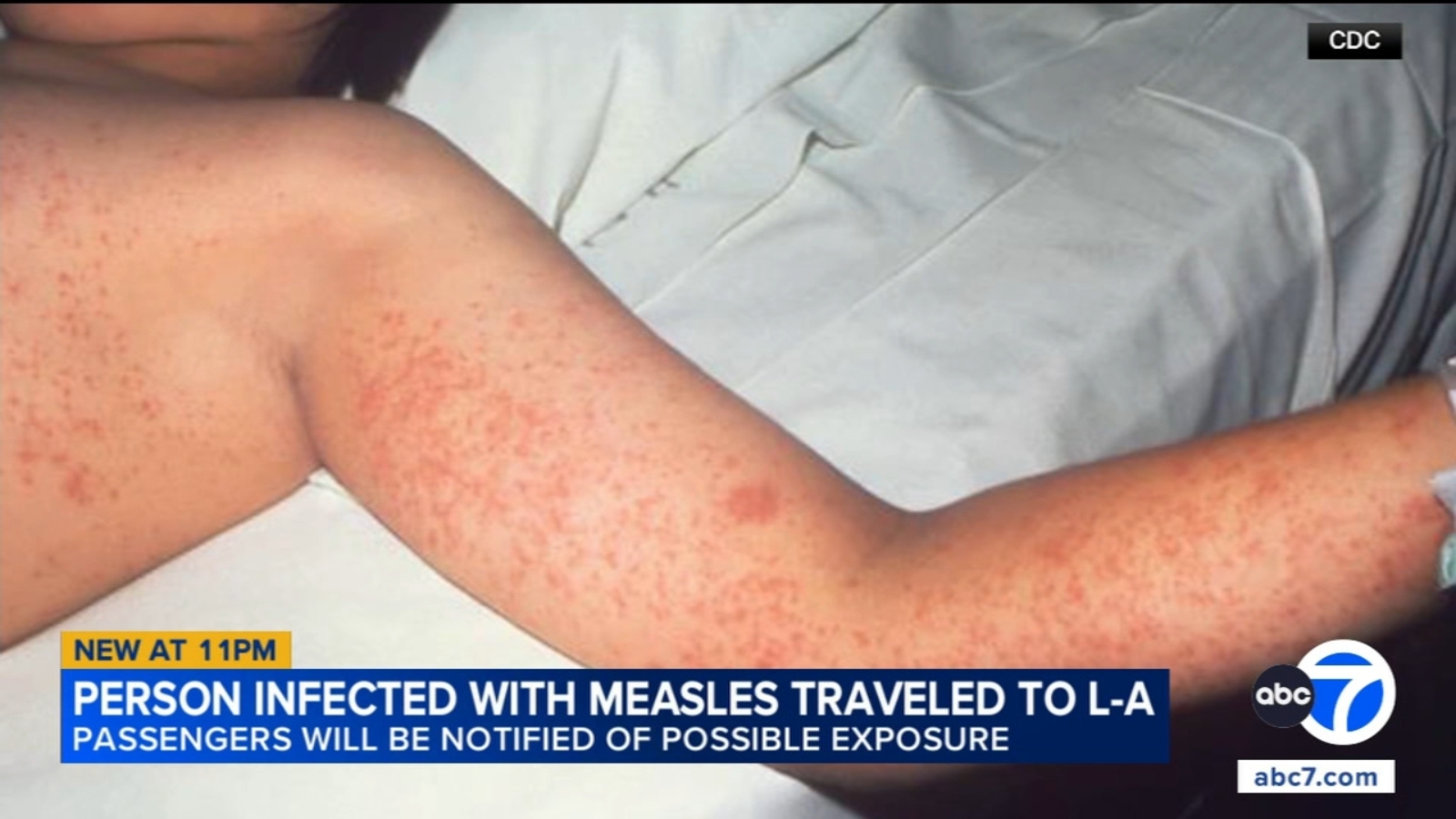 LA Union Station travelers may have been exposed to measles by infected passenger, health officials warned
