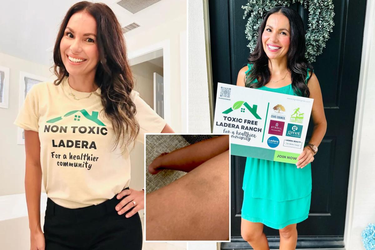 Ladera Ranch mom reveals grisly skin condition she developed in town rocked by Ewing sarcoma