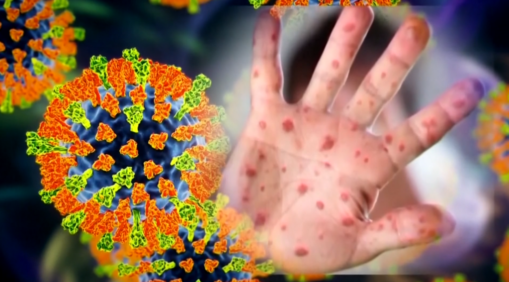 Possible measles exposure Strong emergency department