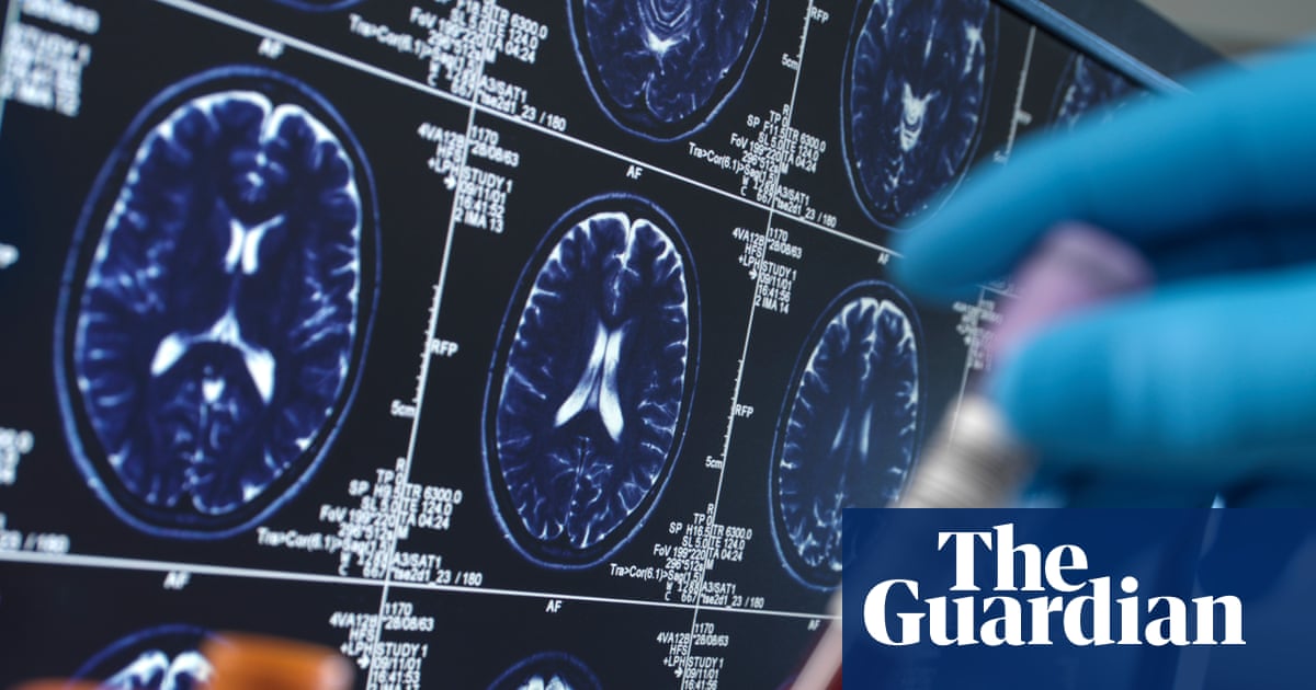 Researchers warn social media driving harmful misuse of Alzheimer’s blood tests | Health