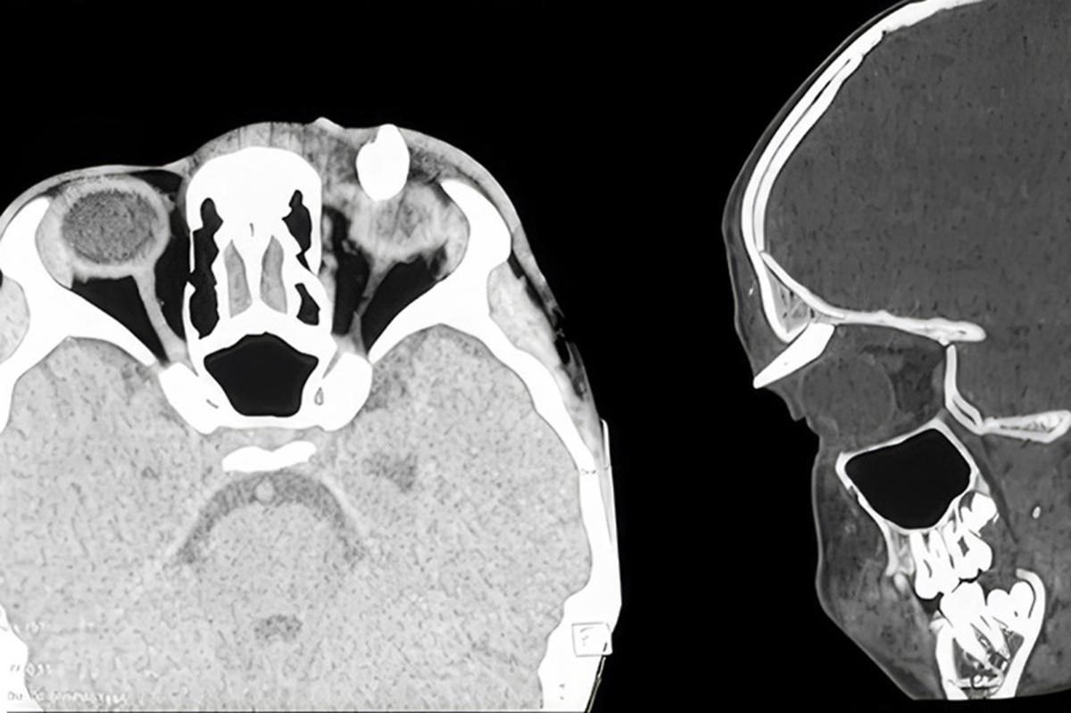 Teen is 'first' patient to have a tooth growing in bizarre place