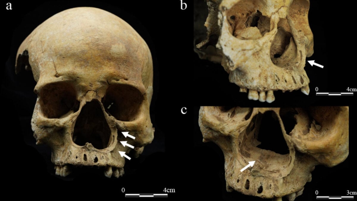 This Skeleton May Prove That Imperial China Really Did Cut Off Noses as Punishment