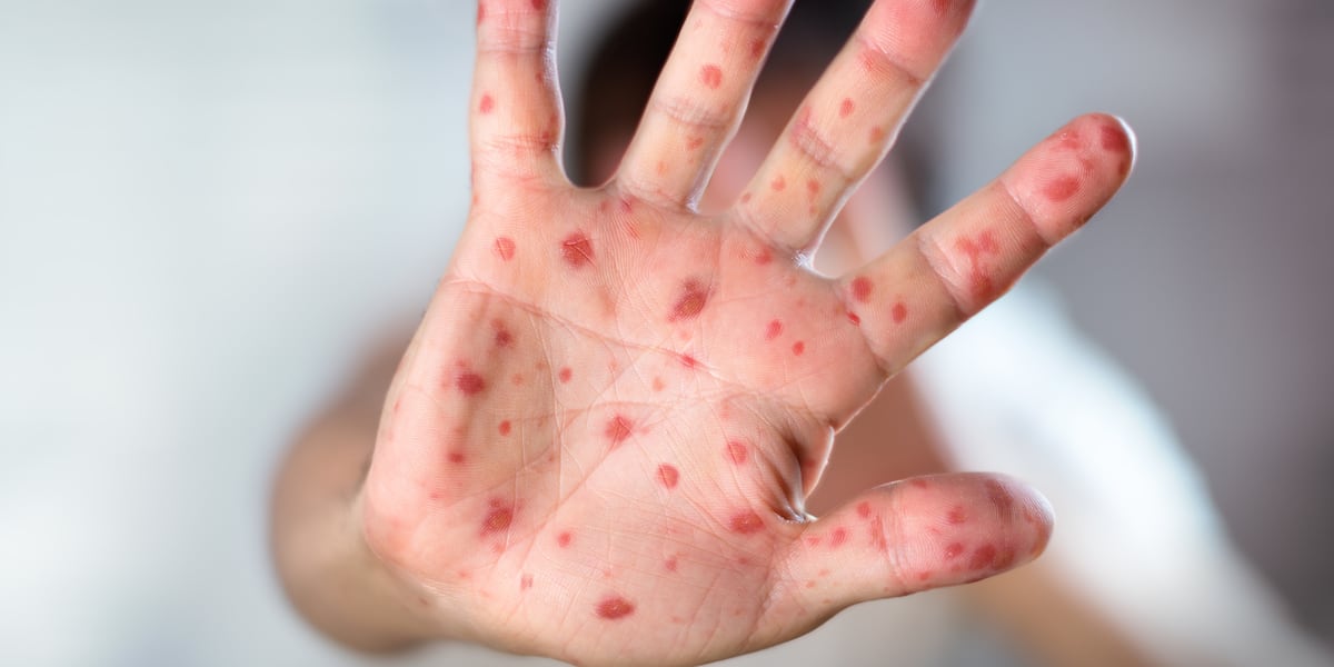 Measles case reported in Huntsville