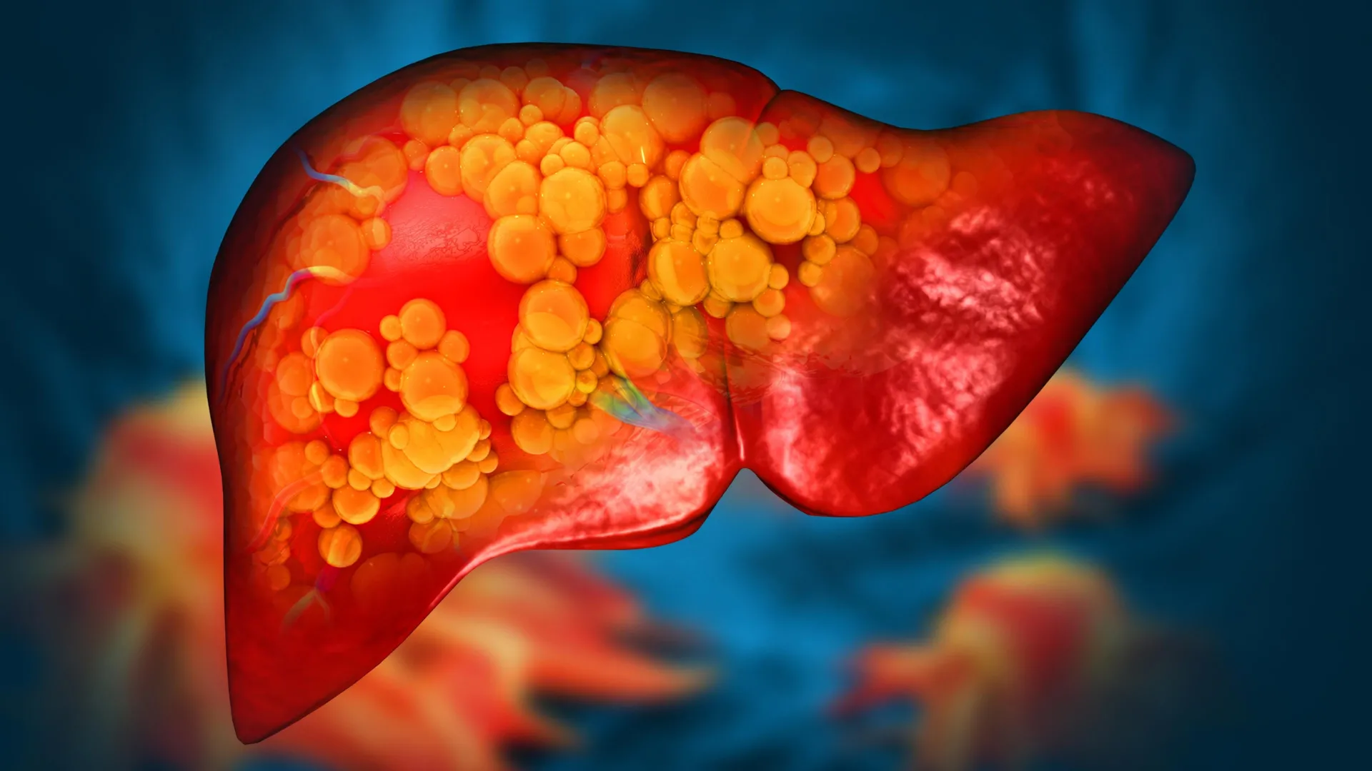 New drug reverses severe fatty liver disease by repairing the gut